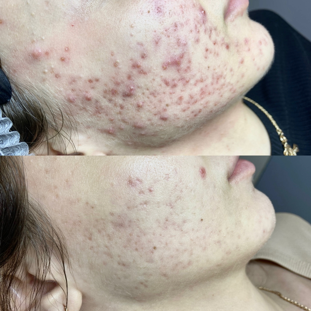 Чистка комбинированная + Biorepeel/ Peach peel