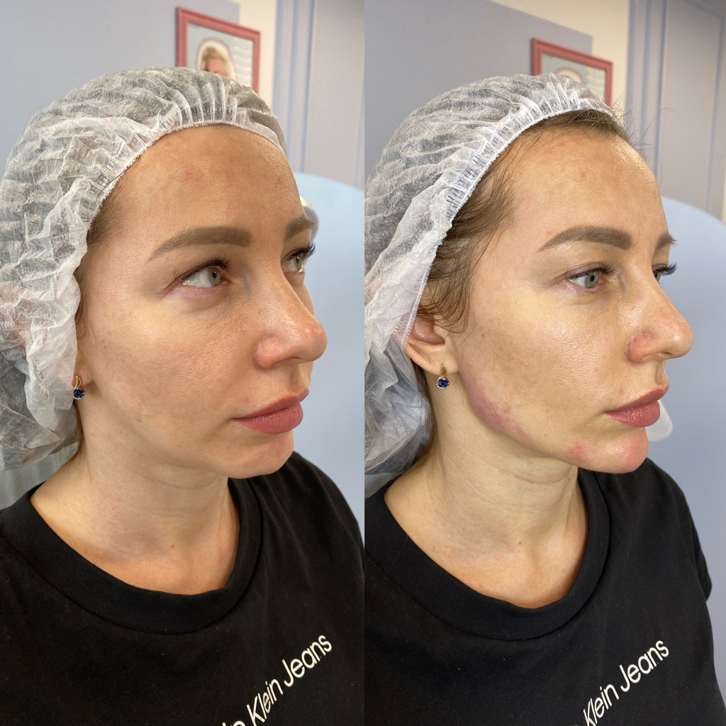 Stylage L, 1ml -контурная пластика средней трети (скулы+ щечки молодости)