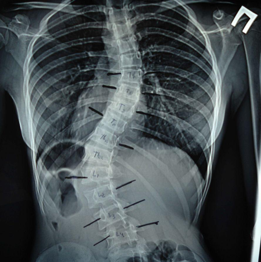 Нарушения осанки