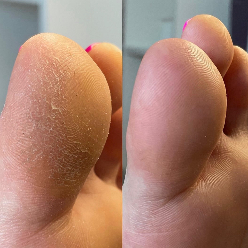 Гигиеническиий Smart-педикюр (пальцы, стопы) без покрытия