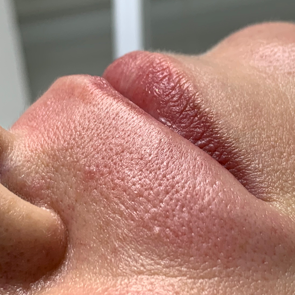 Депиляция зоны над верхней губой