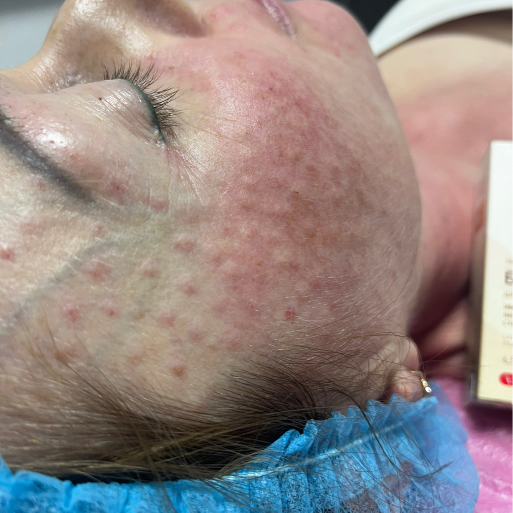 Биоревитализация