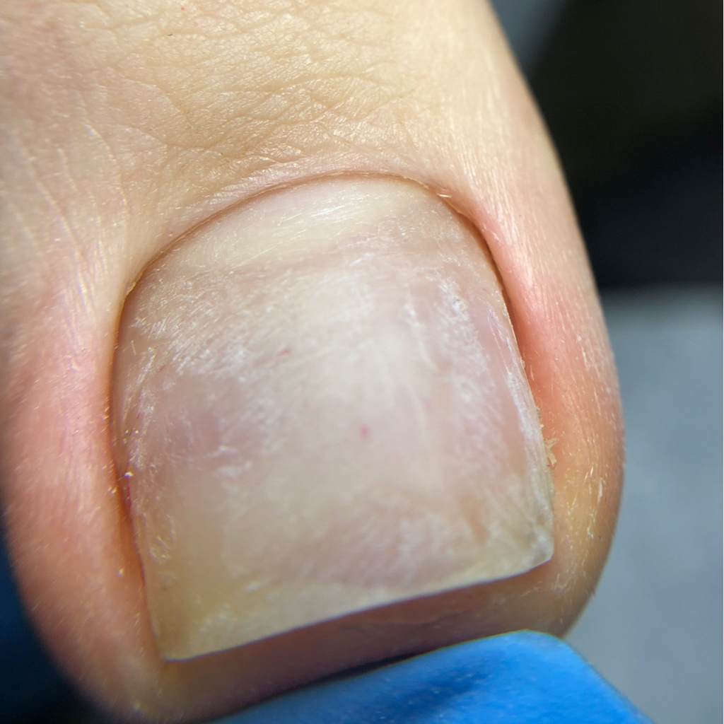 гигиенический педикюр пальчиков