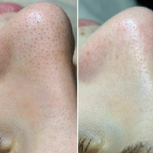 комбинированная чистка лица