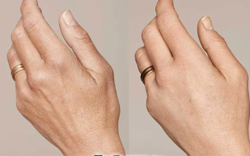 Биоревитализация кожи рук