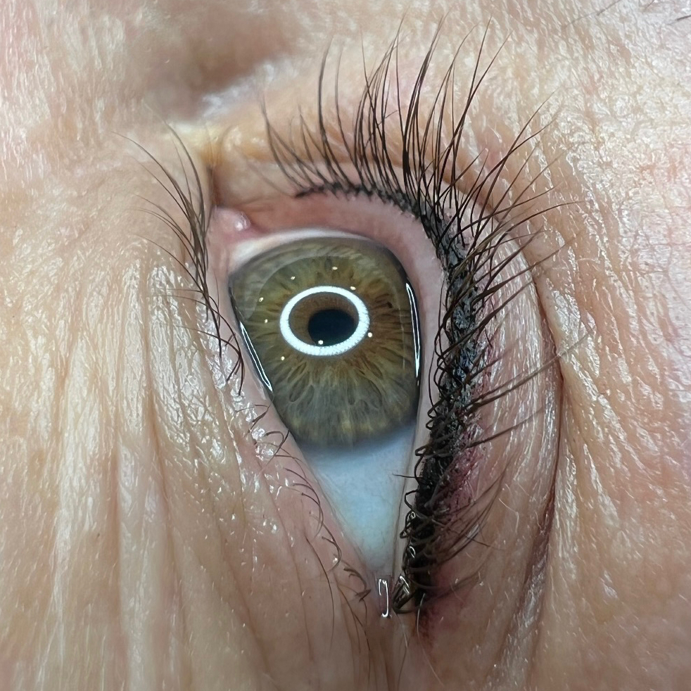 ПМ Межресничка