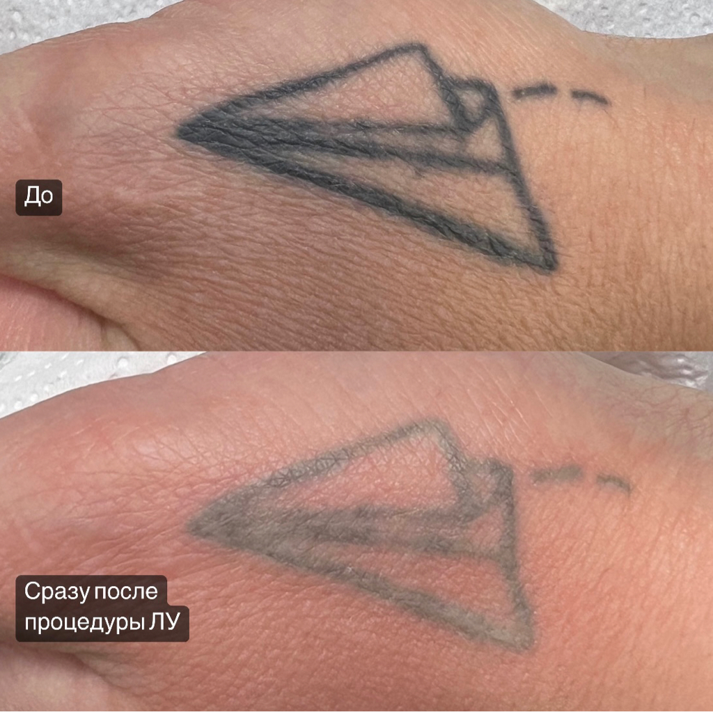 Удаление Татуировки Лазером