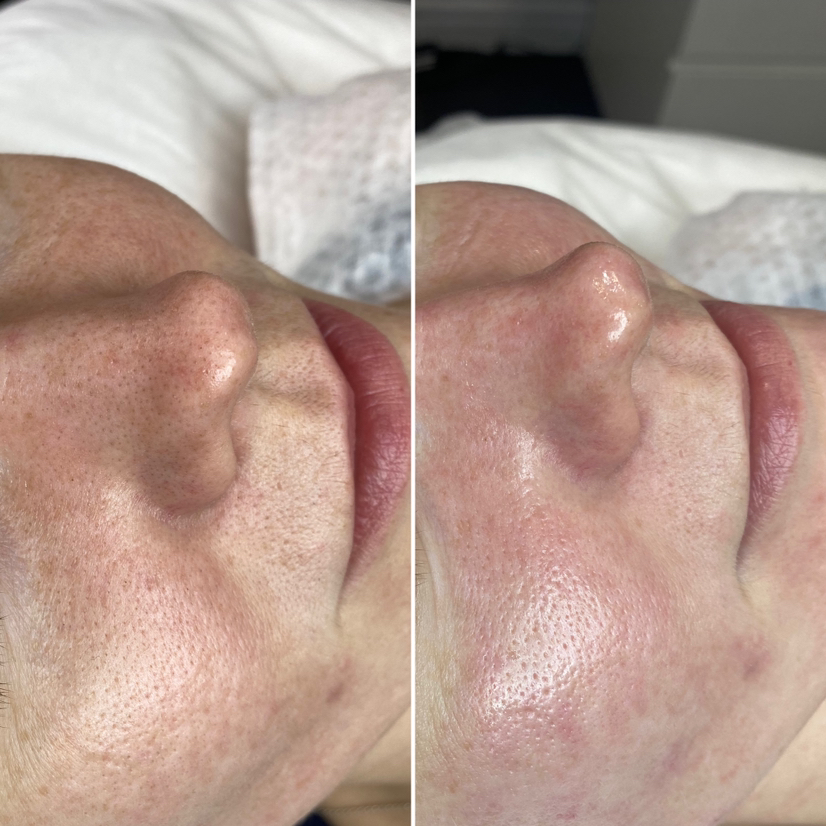 Комбинированная чистка лица