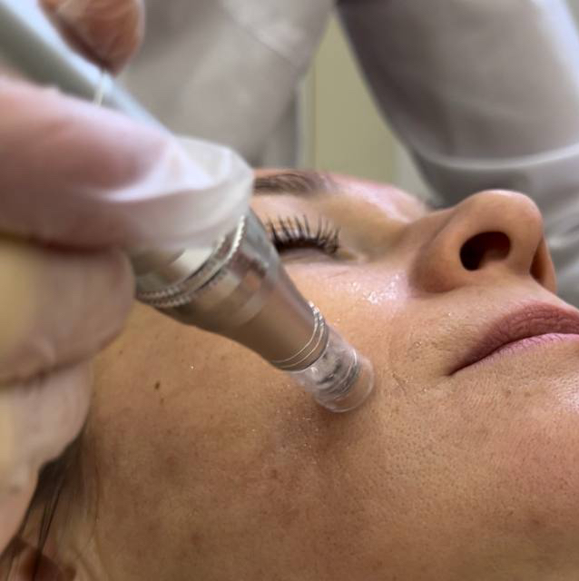 Фракционная мезотерапия лицо-шея-декольте