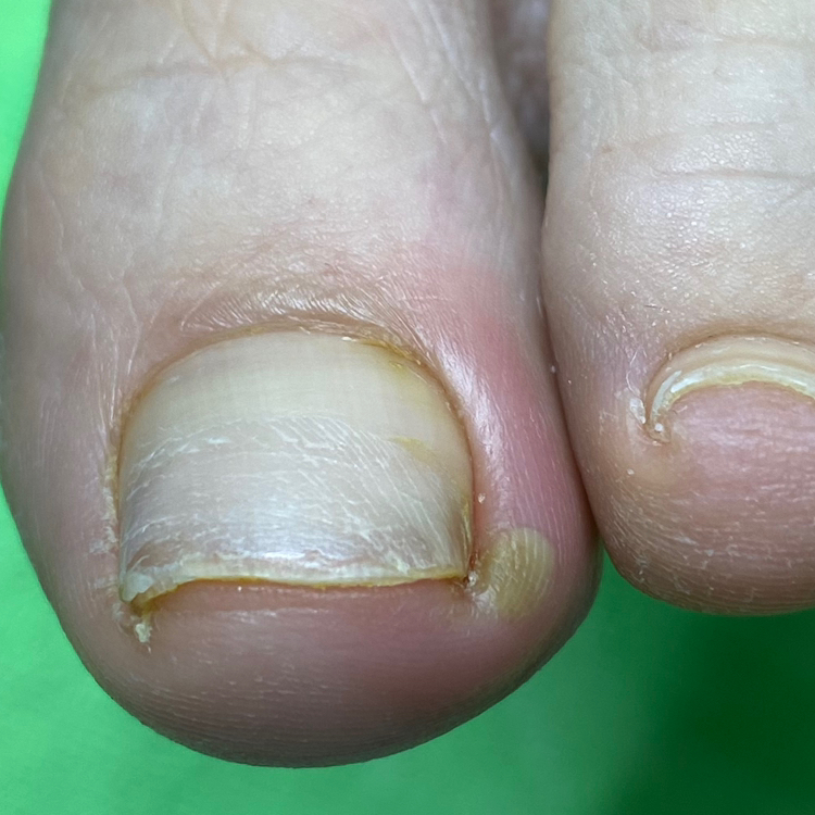 Обработка врастающей части ногтевой пластины 1 ед. (С ОБЯЗАТЕЛЬНЫМ повторным визитом!!!через 3-5 дней)