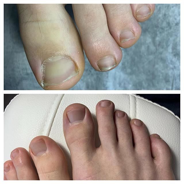 Гигиеническая обработка пальчиков без обработки стопы,без покрытия(без проблем и изменений ногтей)