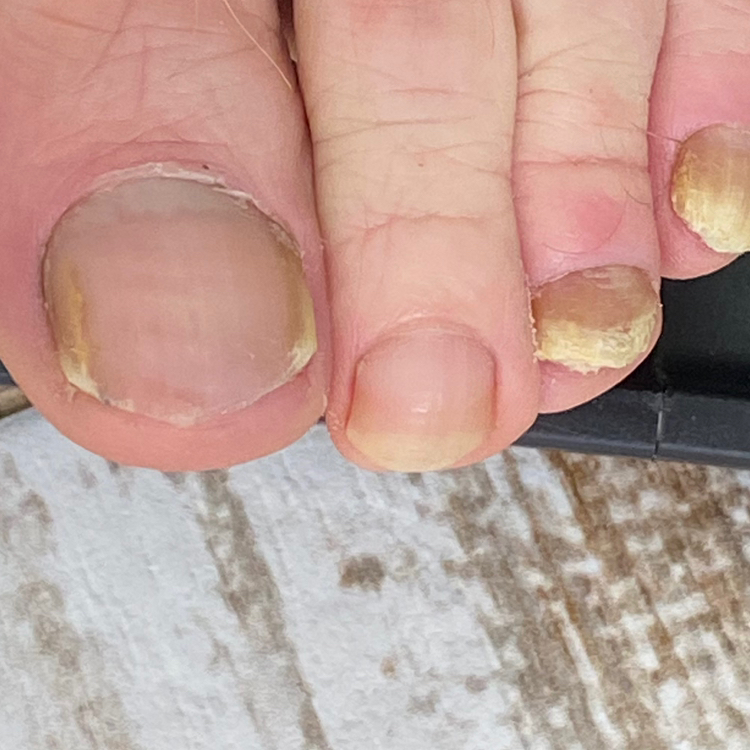 Обработка всех пальчиков ног,ногтевых пластин с изменениями(без стопы)