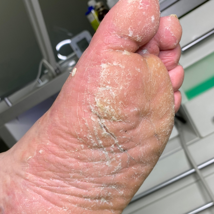 Медицинский педикюр(2-3 степени сложности)