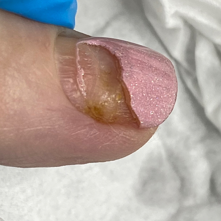 Обработка пальцев рук с повреждениями( 1-3 ед.)