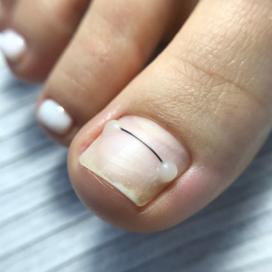 Установка клеевой коррекционной системы