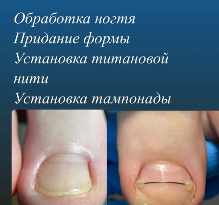 установка титановой нити или лс системы