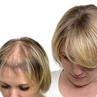 Коррекция системы замещения волос.