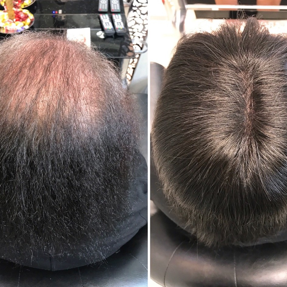 Установка системы замещения волос при алопециях( облысение)