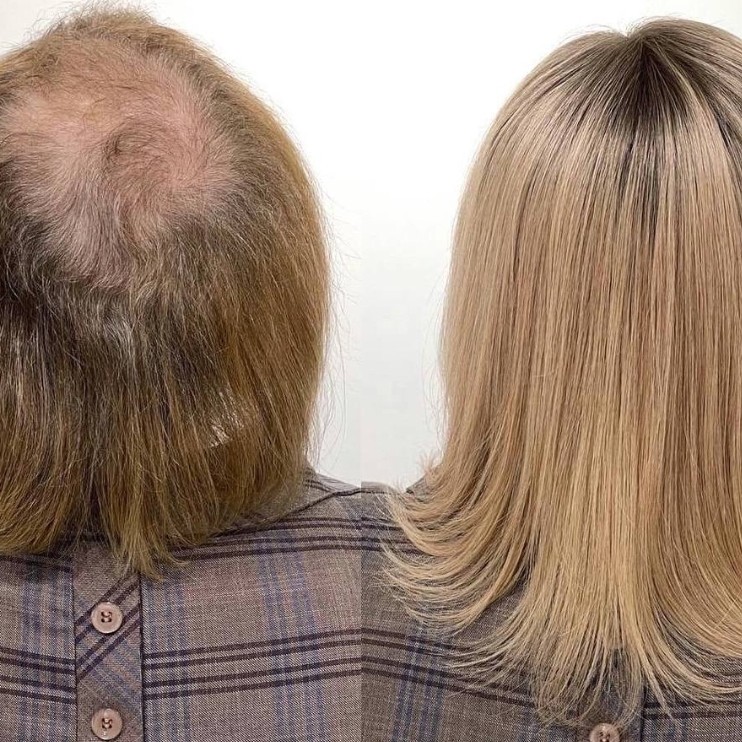 Консультация по наращиванию волос и установке системы замещения волос.