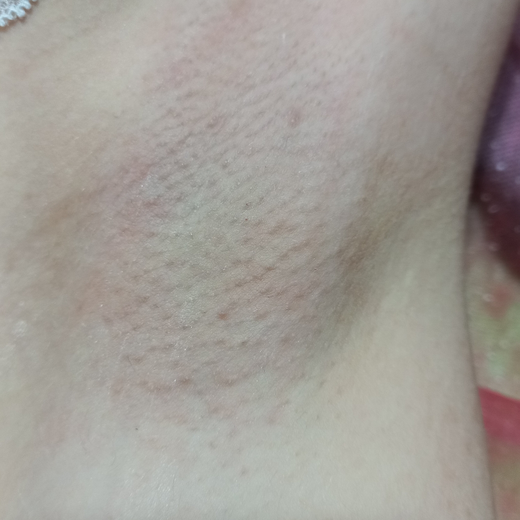 Подмышечные впадины