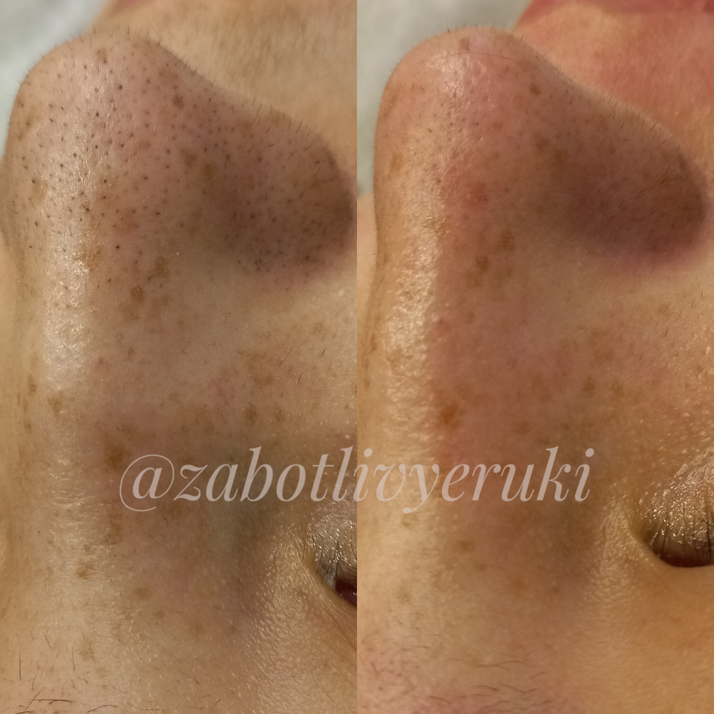 Гигиеническая чистка лица