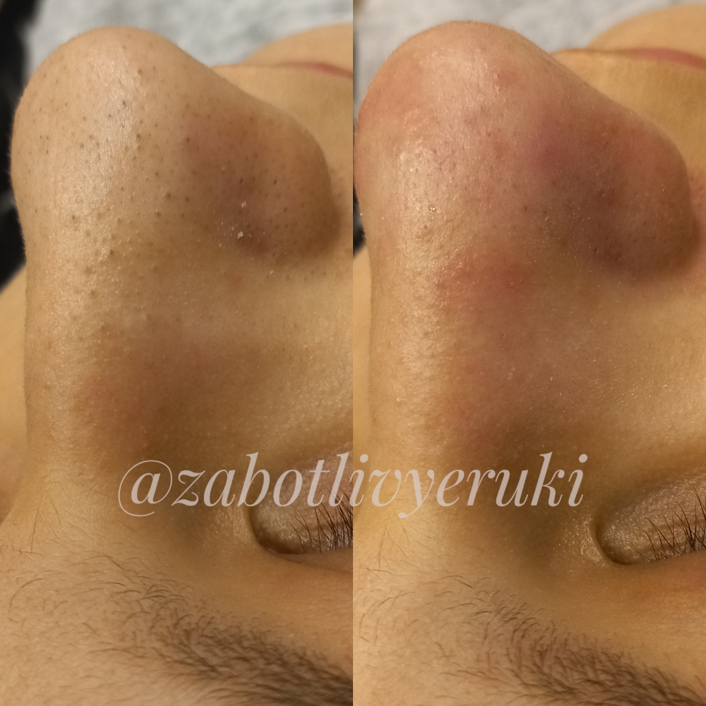 Механическая чистка лица