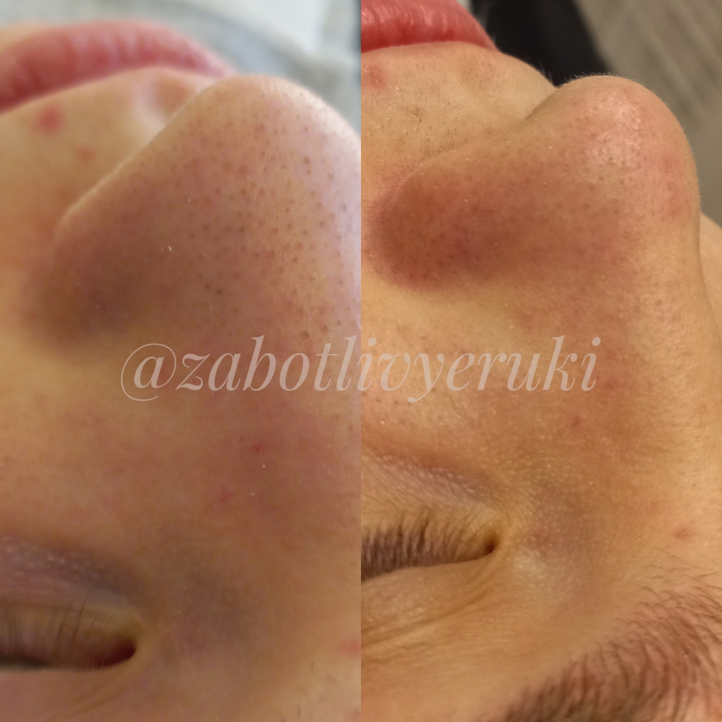 Уз-пилинг лица