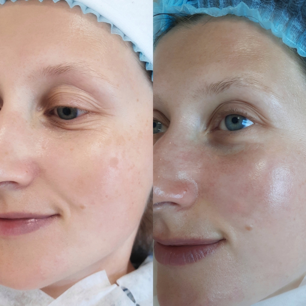 Консультация + пилинг