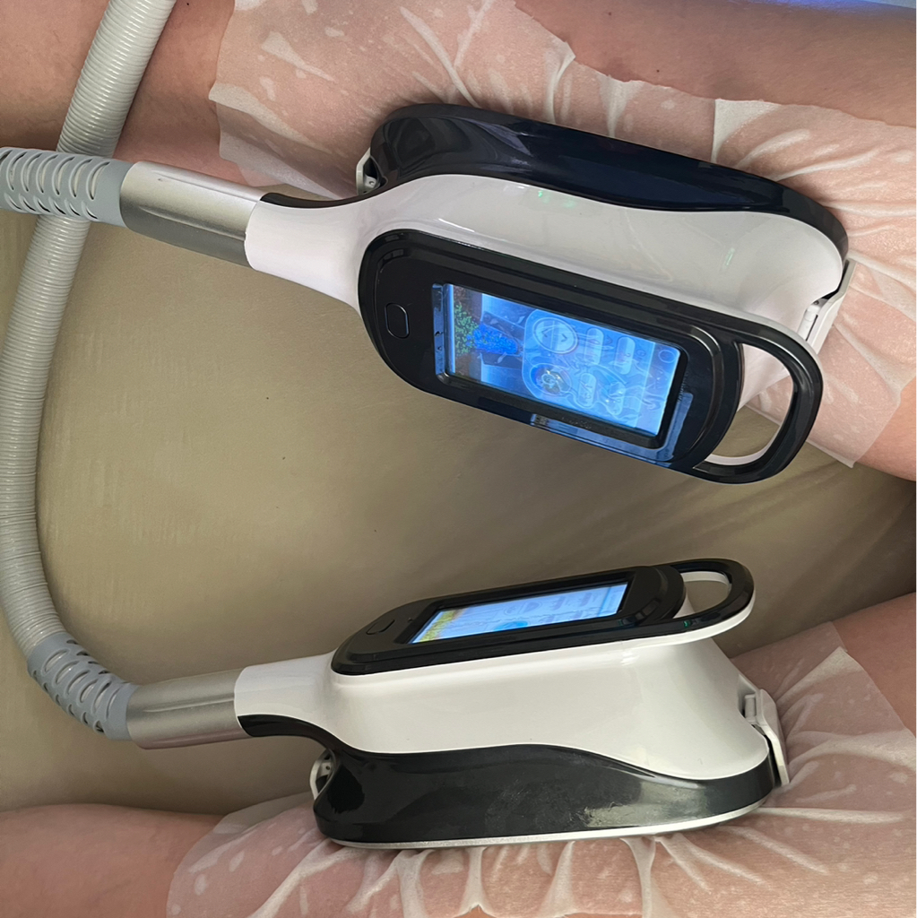 Криолиполиз 1 манипула 1 зона