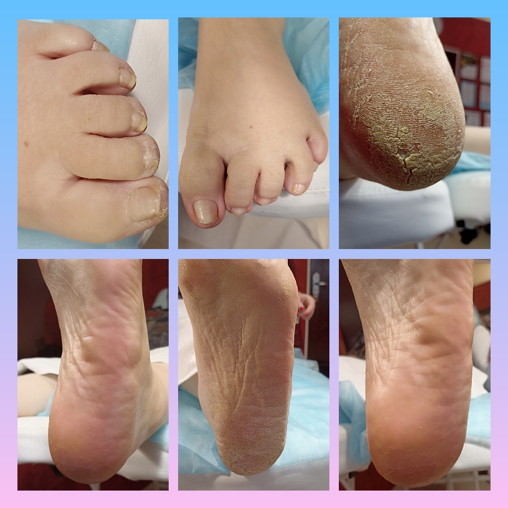 гигиенический педикюр, обработка всей стопы.