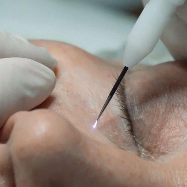 Уход холодная плазма 35+