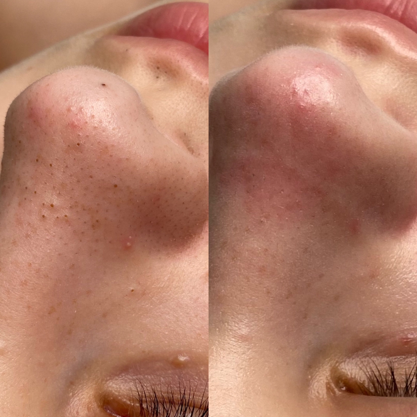 Глубокая чистка лица