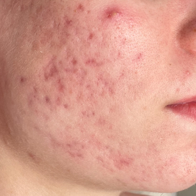 Фракционная мезотерапия (микронидлинг)