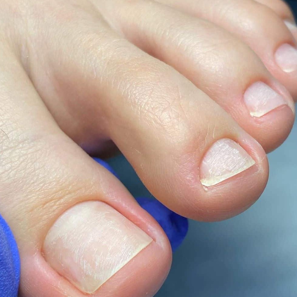 Снятие долговременного покрытия с пальчиков ног