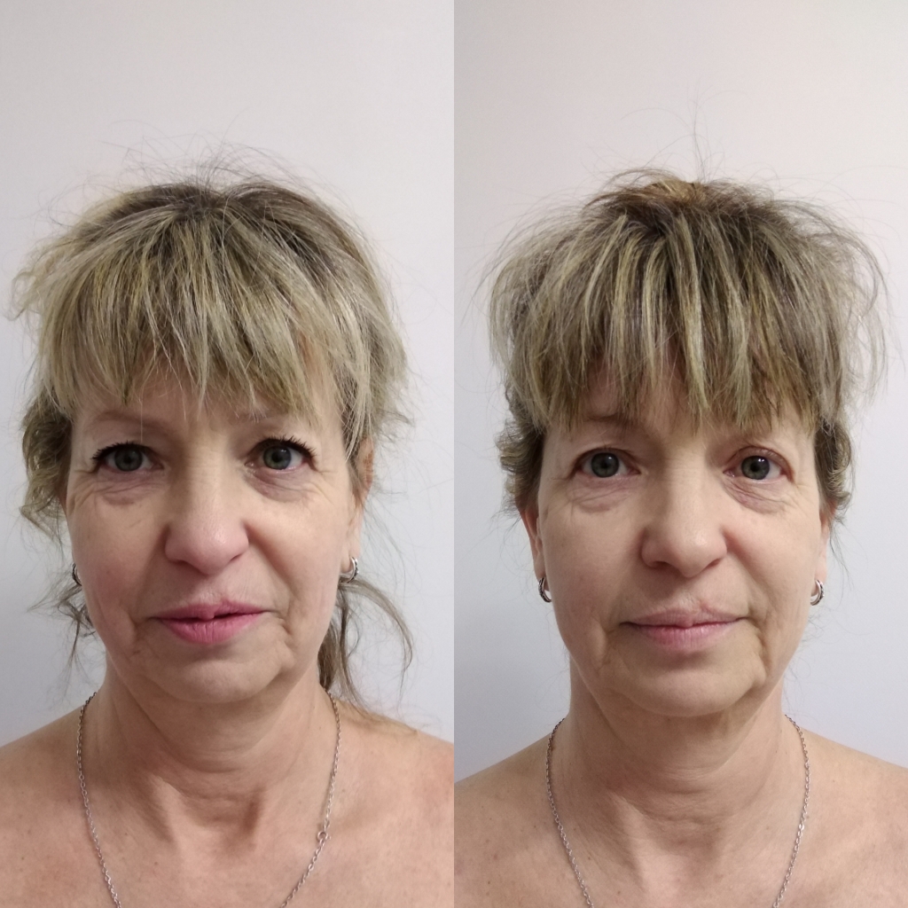 Фейспластика