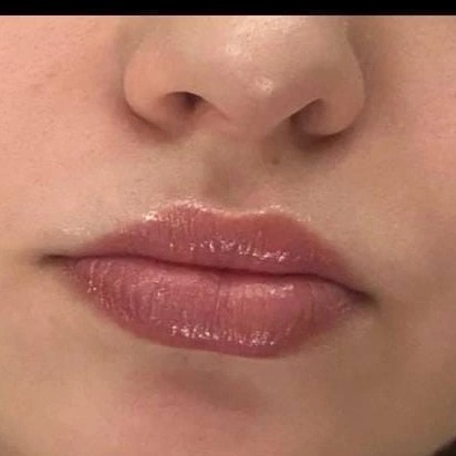 Обновление цвета (1-2,5 года после первичной процедуры)