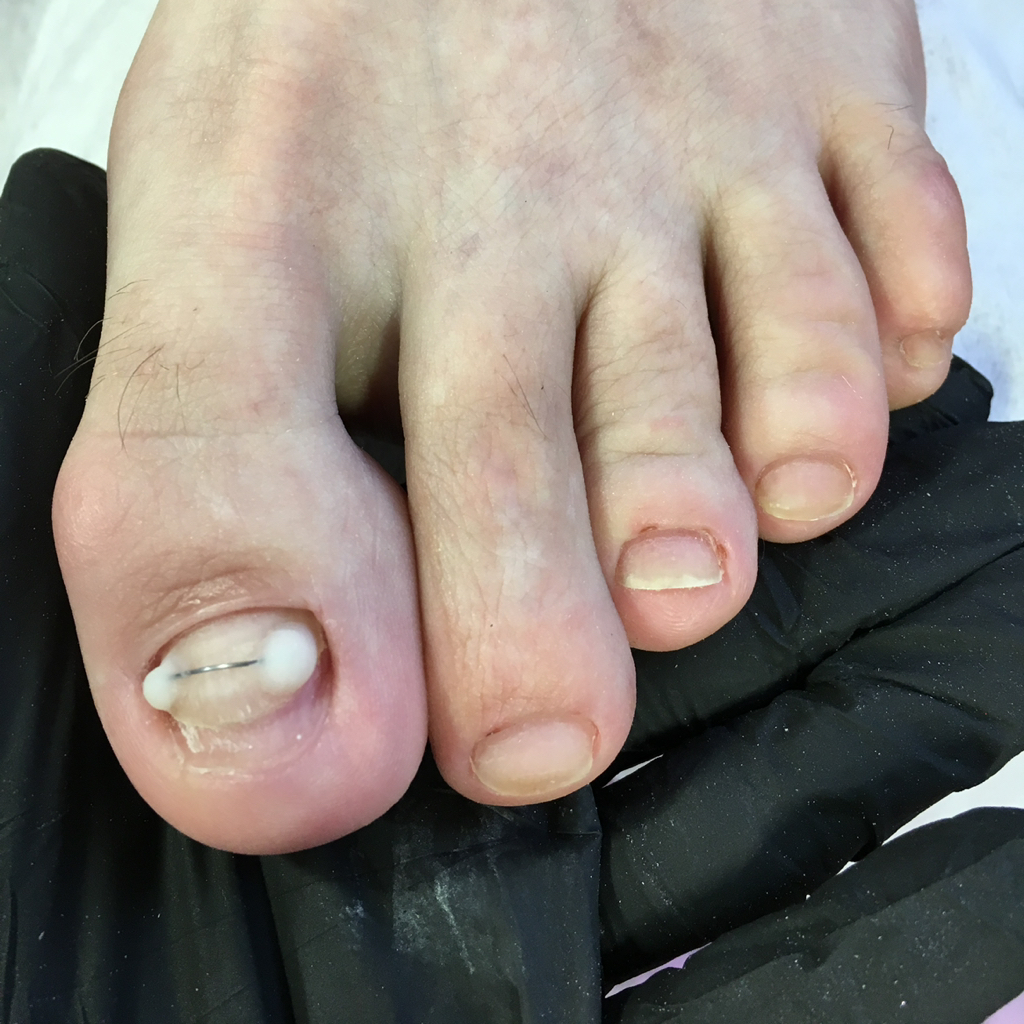 Установка коррекционной системы титановая нить