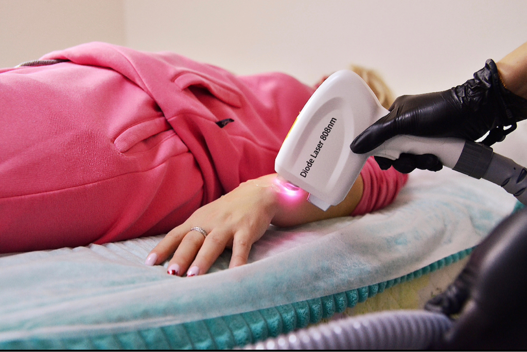 Лазерная эпиляция