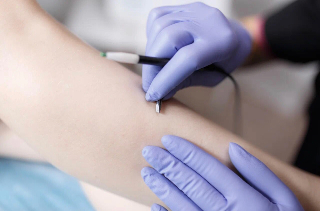 Электроэпиляция