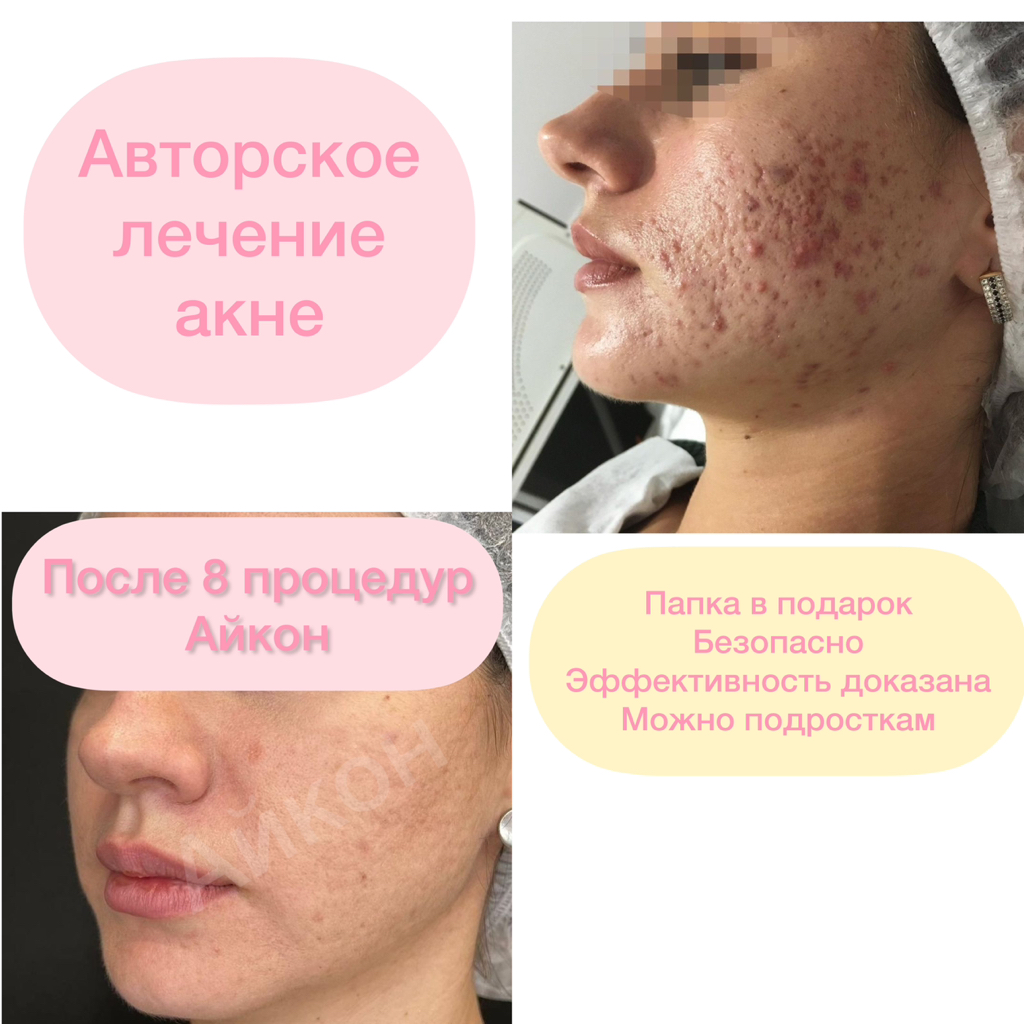 Авторское лечение акне+ механическая чистка
