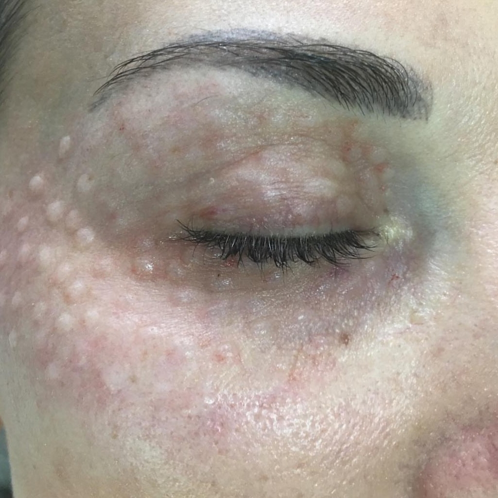 БР кожи вокруг глаз