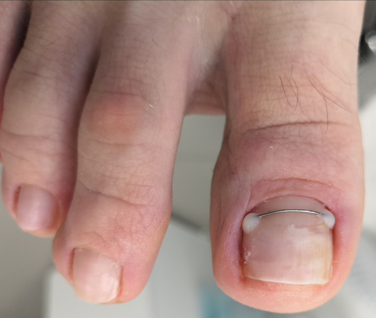 Коррекция «Титановой нити»1 ногтевая пластина (не позднее 30-45 дней)