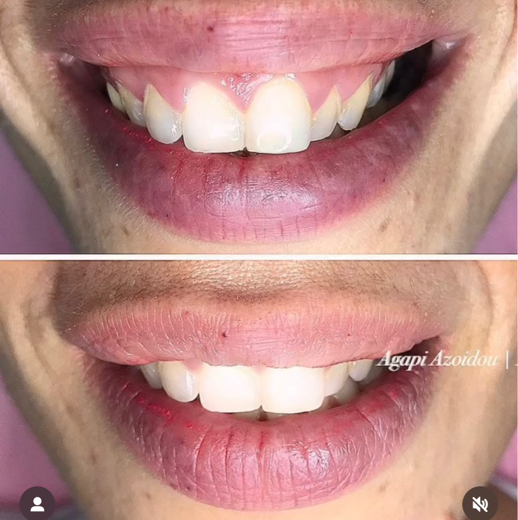 HOLLYWOOD SMILE