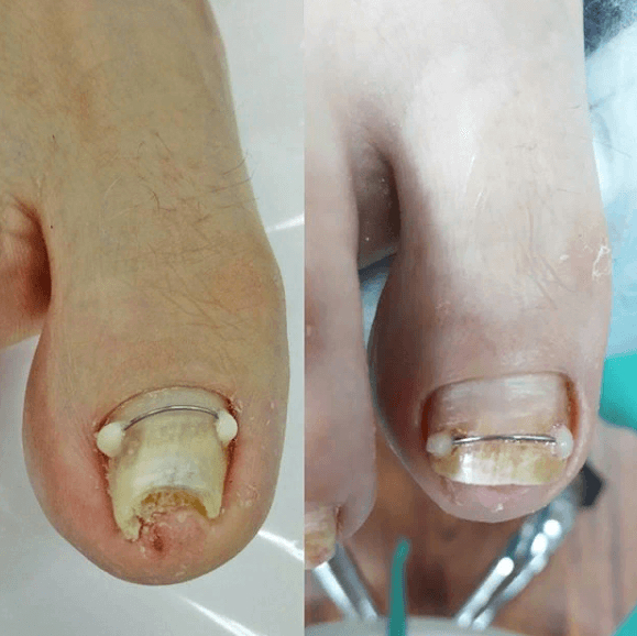 Установка корректирующей системы«Титановая нить» 1 ногтевая пластина(первичная)гарантия 7 дней