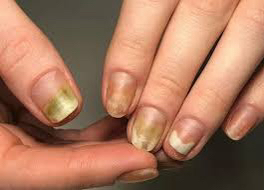 Обработка ногтевых пластин пальцев рук с повреждениями(более 3-4 ед.)