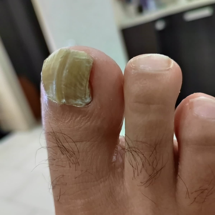 Обработка 1-3 ногтевой пластины с изменениями (грибок,утолщение,гематома,онихолизис…)консультация,рекомендации