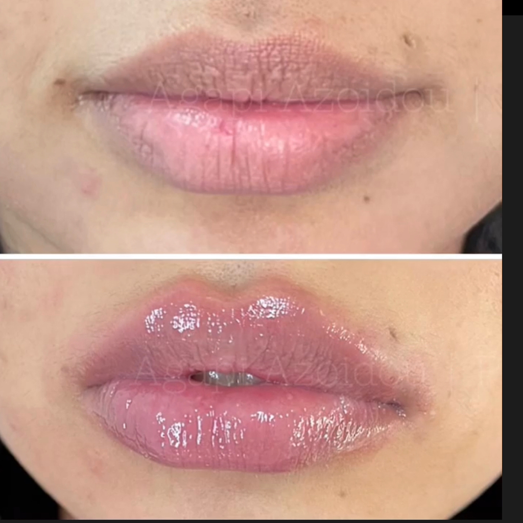 RUSSIAN LIPS (Juvéderm 3) 
1 ml