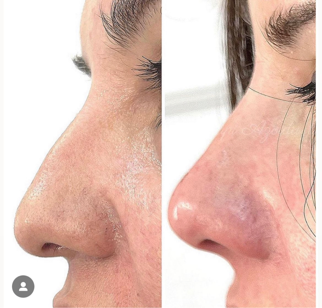 BABY NOSE
Δύο συνεδρίες 
(130+130)
Σε 20 ημέρες δεύτερη συνεδρία