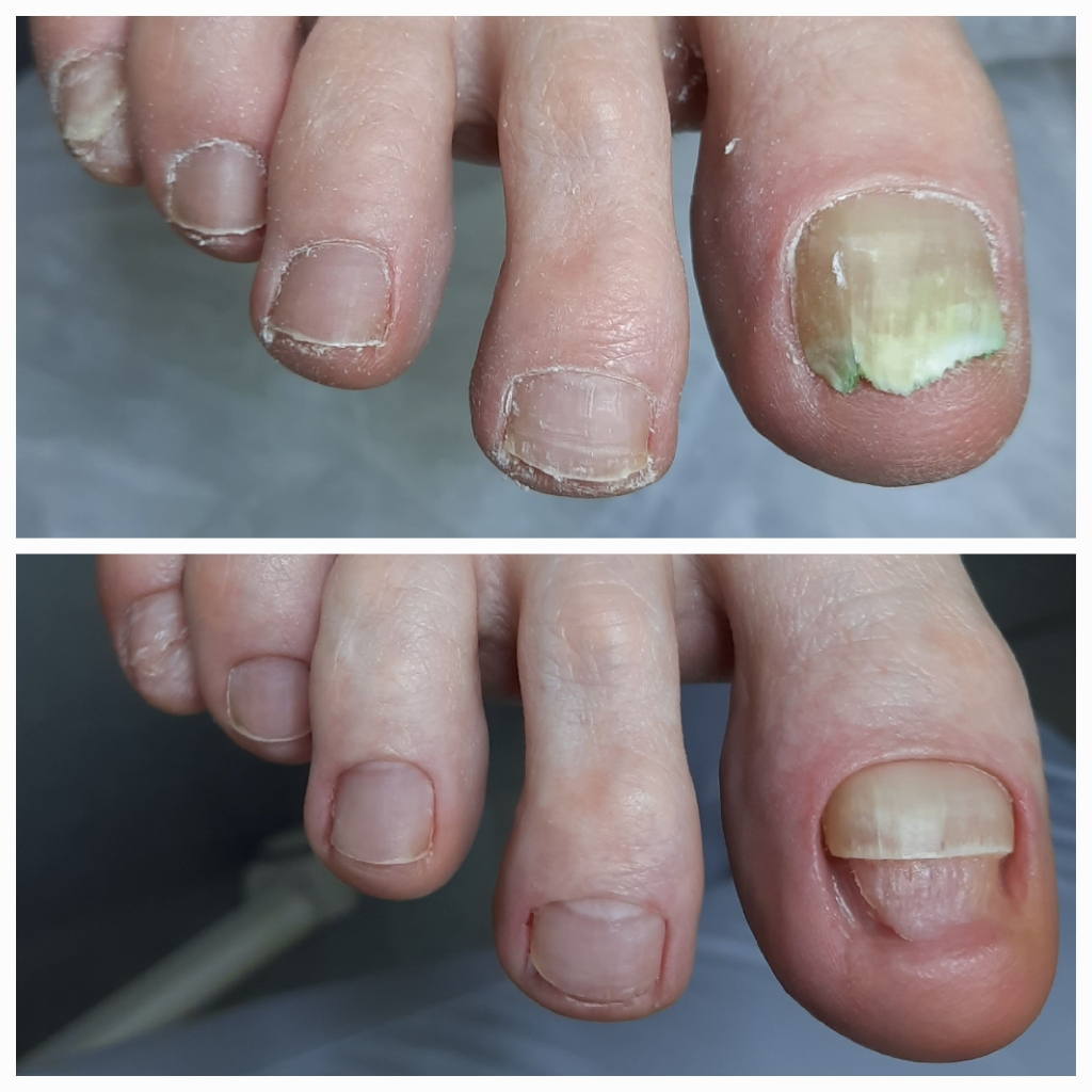 Педикюр  сложной стопы