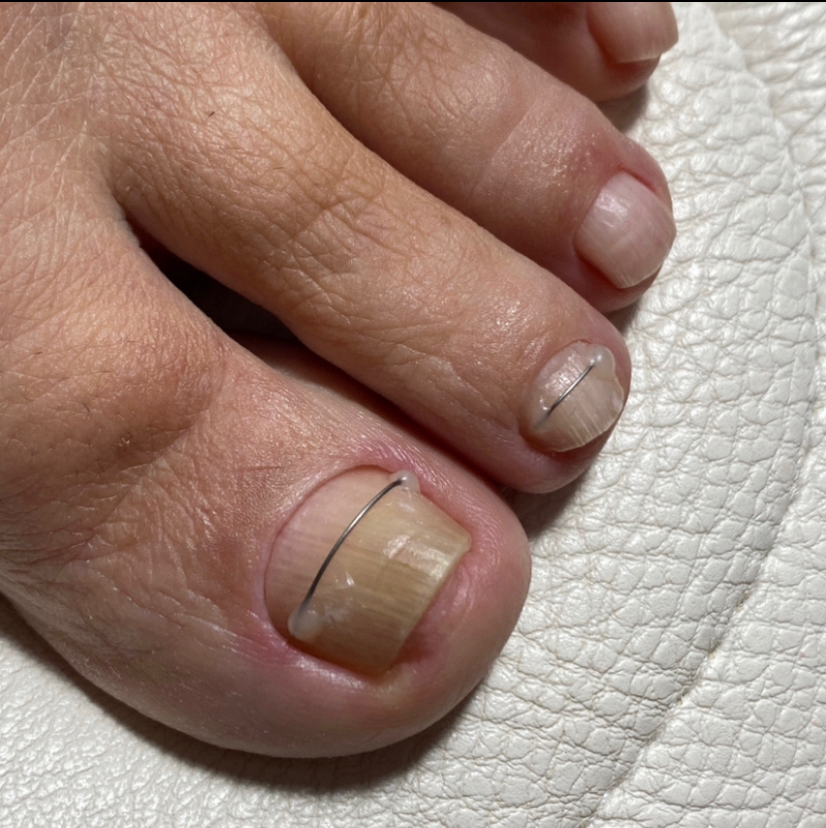 Выпрямление 2-5 ноготя